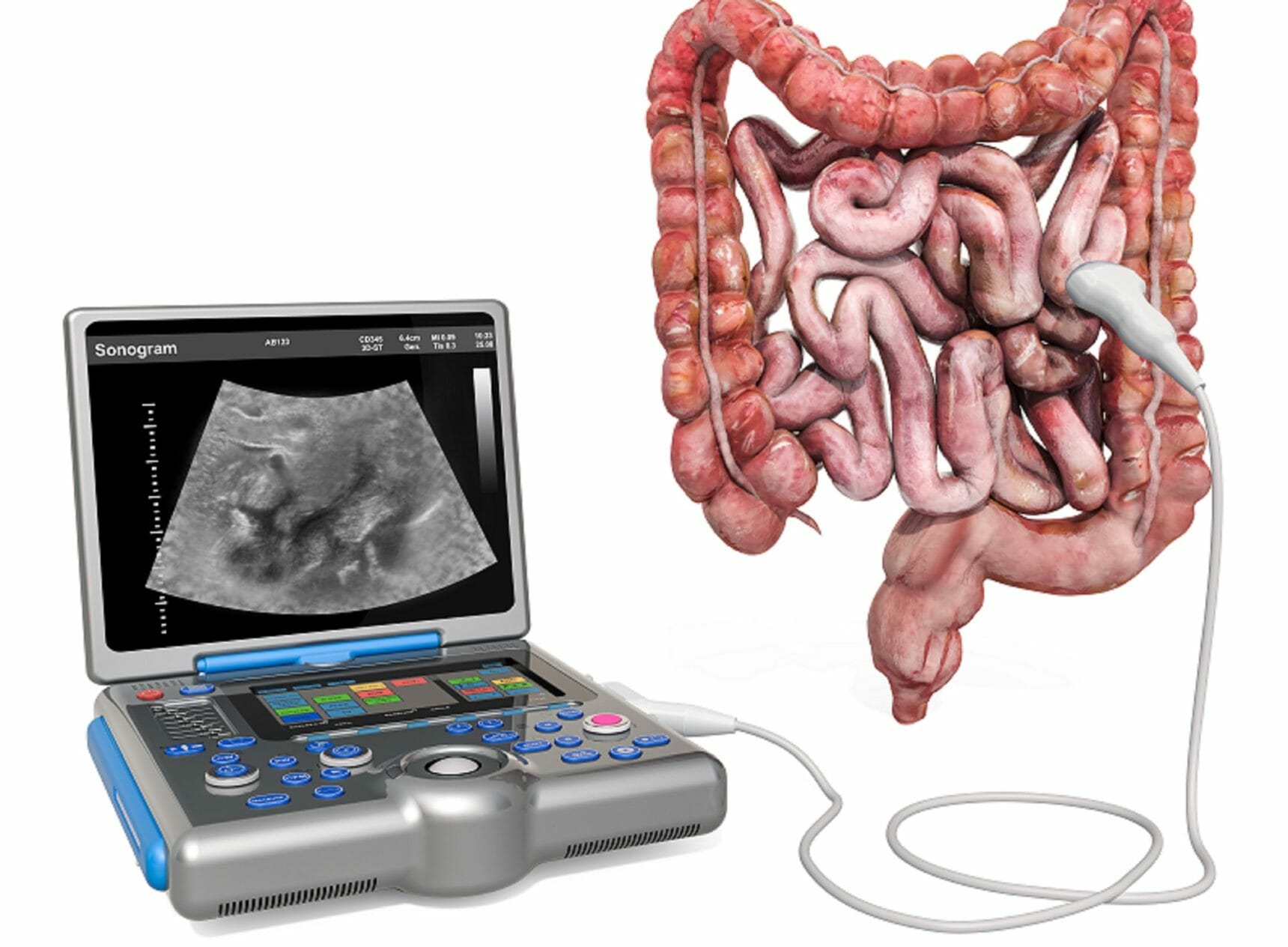 Intestinal Ultrasonography