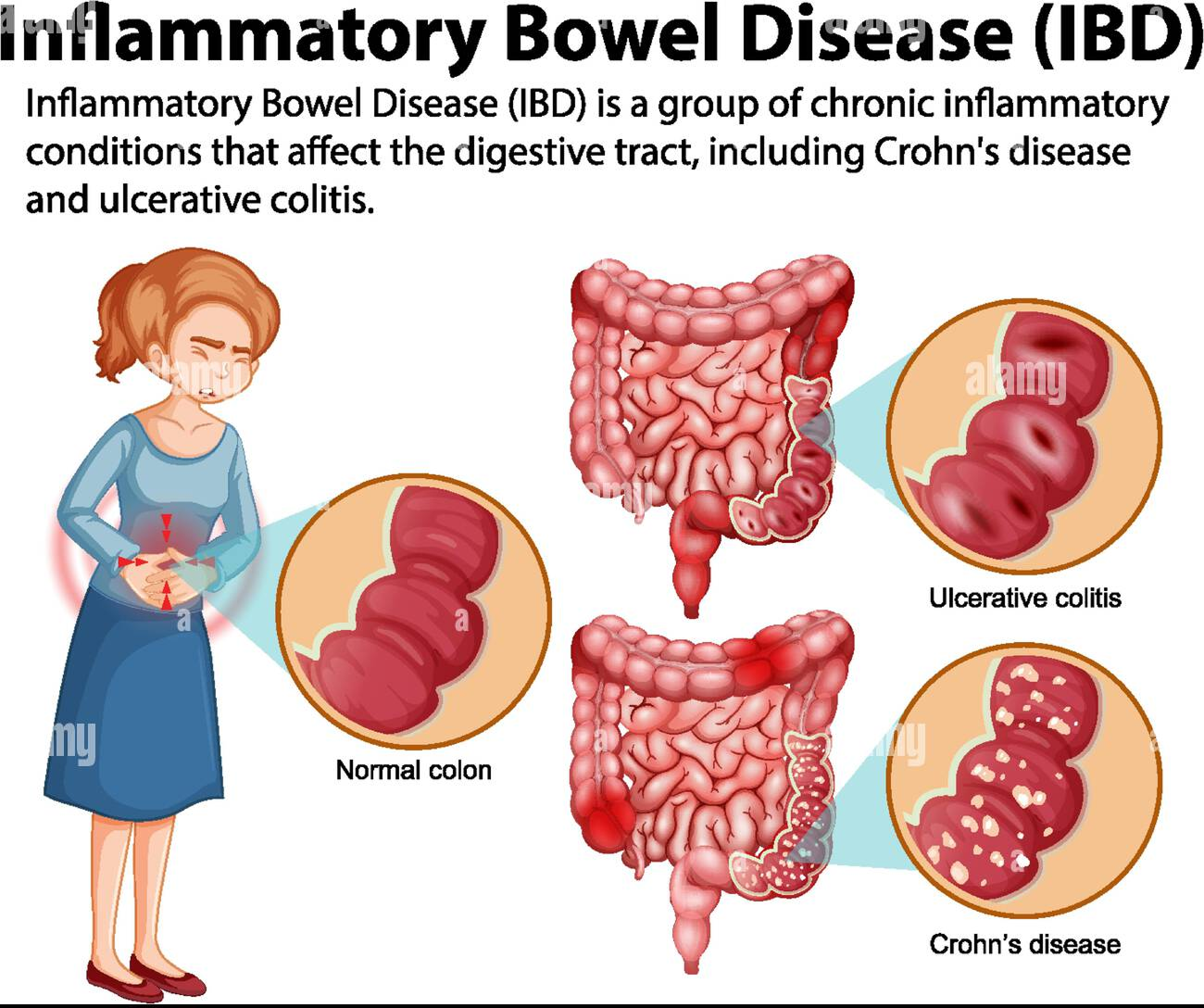 IBD in Children and Adolescents